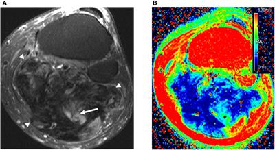 MRI T2 mapping assessment of T2 relaxation time in desmoid tumors as a quantitative imaging biomarker of tumor response: preliminary results